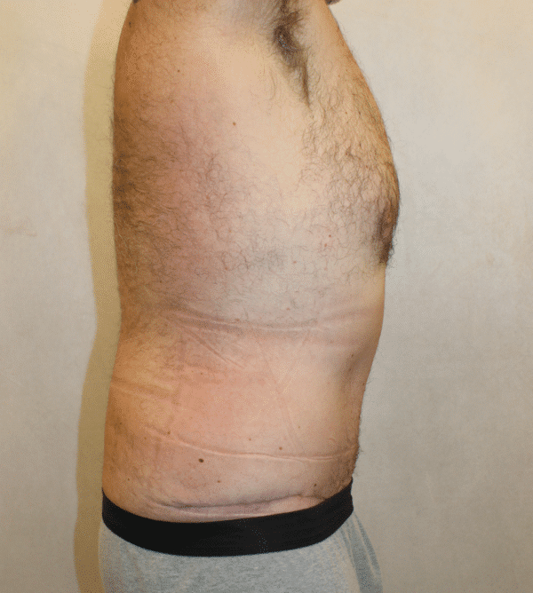 After Image: Case #4910 – Abdominoplasty – Tummy Tuck - right-side