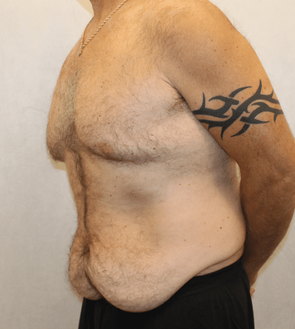 Before Image: Case #4910 – Abdominoplasty – Tummy Tuck - left-front-oblique