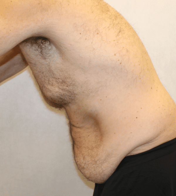 Before Image: Case #4910 – Abdominoplasty – Tummy Tuck - left-front-oblique