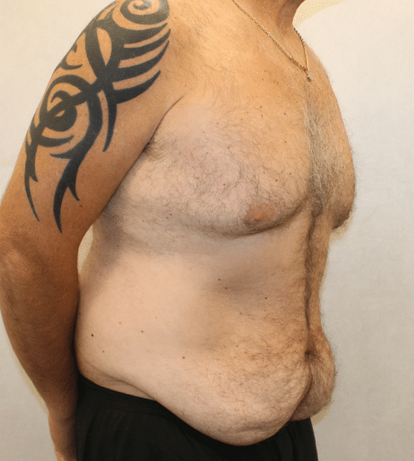 Before Image: Case #4910 – Abdominoplasty – Tummy Tuck - right-front-oblique