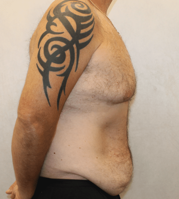 Before Image: Case #4910 – Abdominoplasty – Tummy Tuck - right-side
