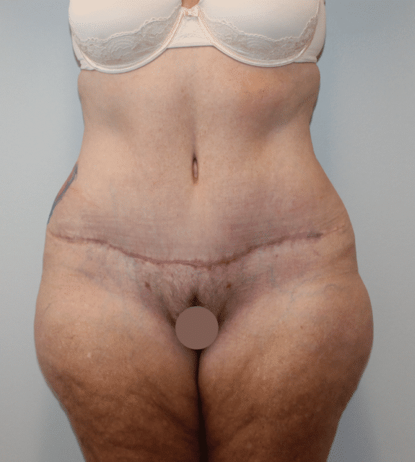 After Image: Case #4971 – Abdominoplasty – Tummy Tuck - front