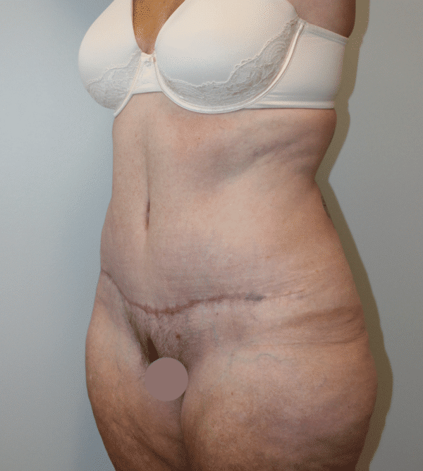 After Image: Case #4971 – Abdominoplasty – Tummy Tuck - left-front-oblique