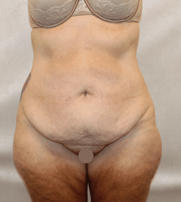 Case #4971 – Abdominoplasty – Tummy Tuck