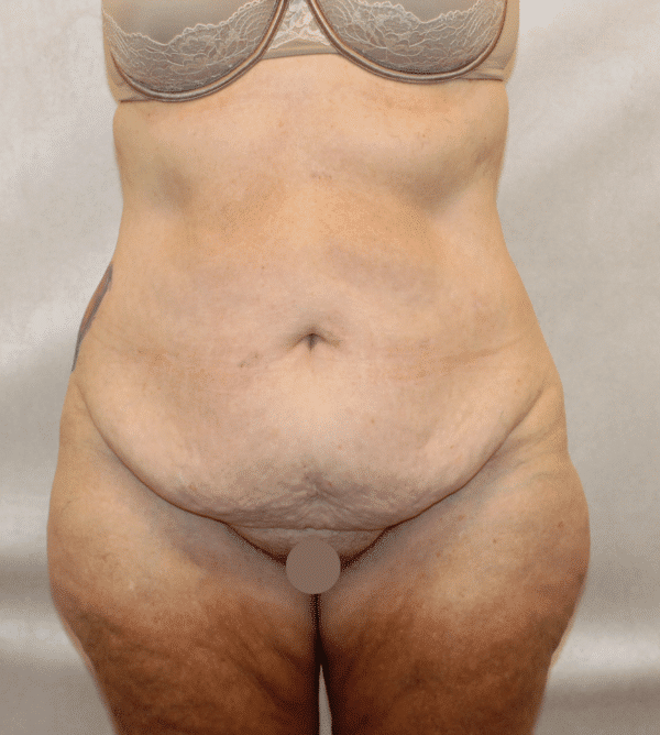 Before Image: Case #4971 – Abdominoplasty – Tummy Tuck - front