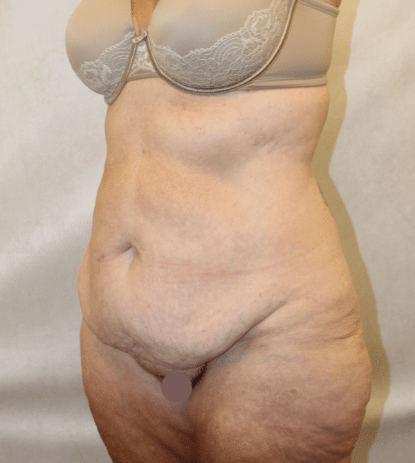Before Image: Case #4971 – Abdominoplasty – Tummy Tuck - left-front-oblique