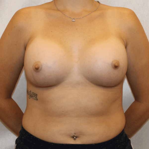 After Image: Case #5009 – Breast Augmentation - front