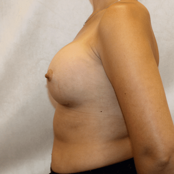 After Image: Case #5009 – Breast Augmentation - left-side