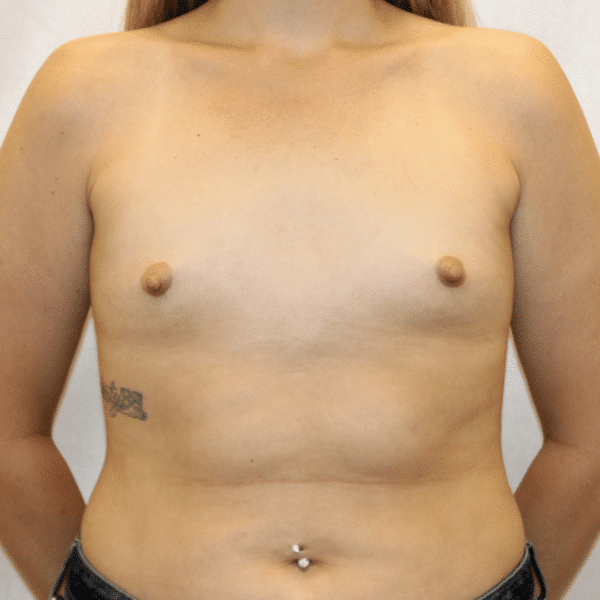 Case #5009 – Breast Augmentation