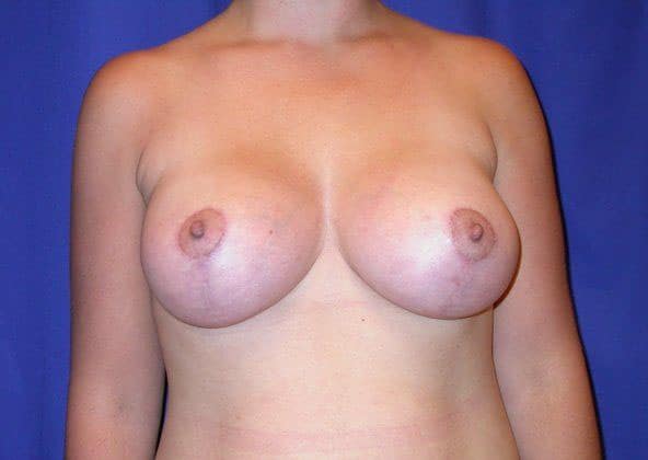 Case #502 – Breast Lift with Implants