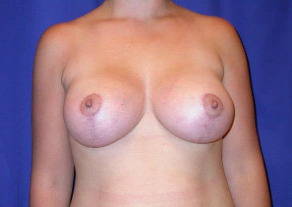 After Image: Case #502 – Breast Lift with Implants - front