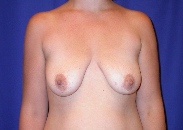 Before Image: Case #502 – Breast Lift with Implants - front