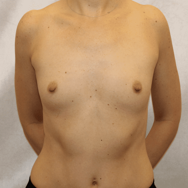 Case #5098 – Breast Augmentation