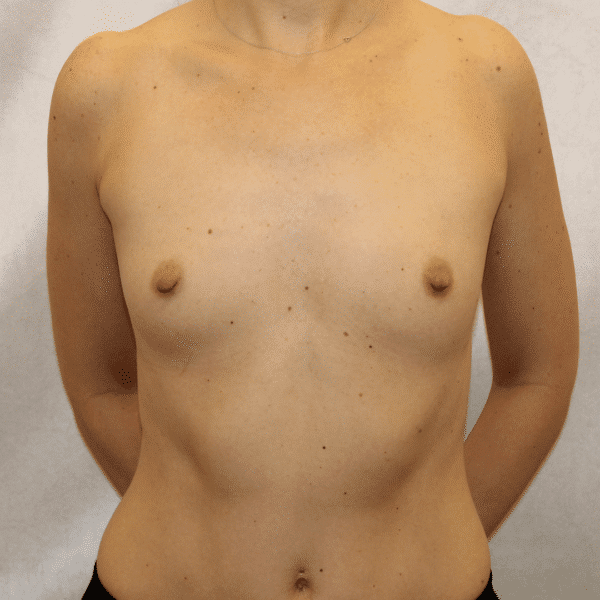 Before Image: Case #5098 – Breast Augmentation - front
