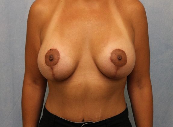 Case #514 – Breast Lift with Implants