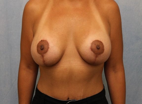 After Image: Case #514 – Breast Lift with Implants - front