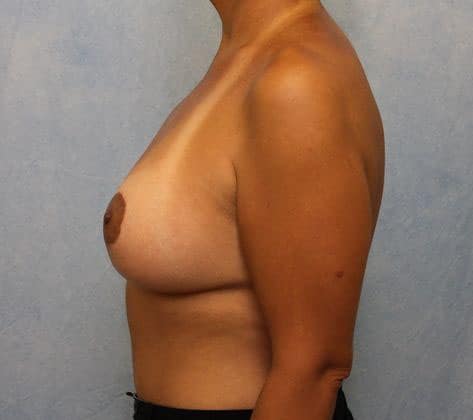 After Image: Case #514 – Breast Lift with Implants - left-side