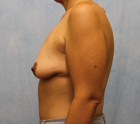 Before Image: Case #514 – Breast Lift with Implants - left-side