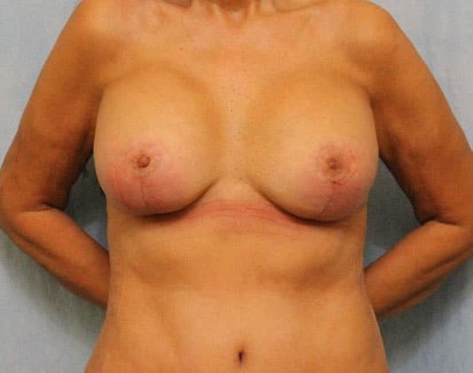 After Image: Case #526 – Breast Lift with Implants - front