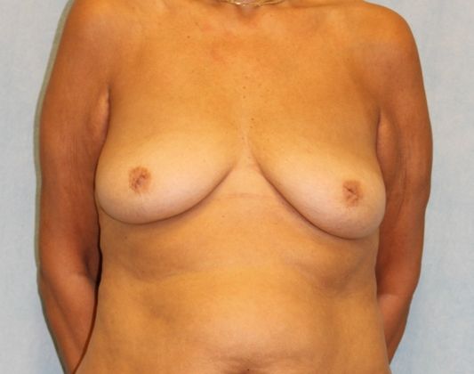 Before Image: Case #526 – Breast Lift with Implants - front