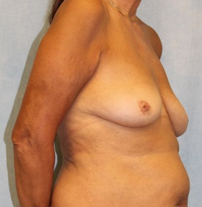 Before Image: Case #526 – Breast Lift with Implants - right-front-oblique