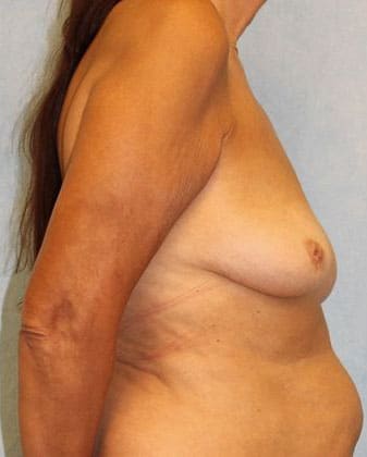 Before Image: Case #526 – Breast Lift with Implants - right-side