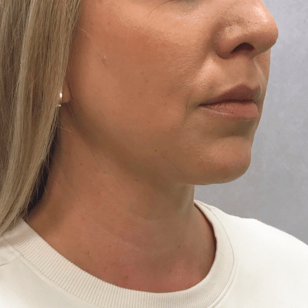 After Image: Case #5266 – Anterior Platysmaplasty - right-front-oblique