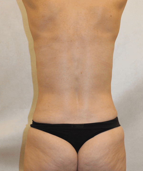 After Image: Case #5300 – Abdominoplasty – Tummy Tuck - back