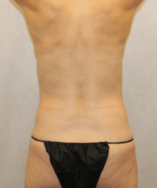 Before Image: Case #5300 – Abdominoplasty – Tummy Tuck - back