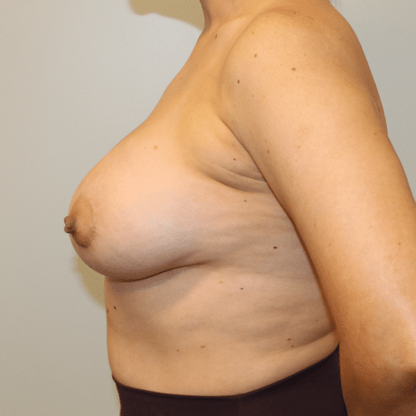 After Image: Case #5326 – Breast Lift with Implants - left-side