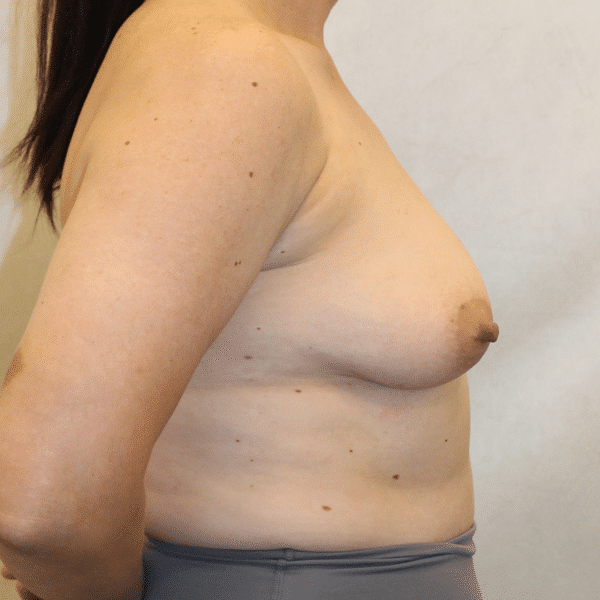 Before Image: Case #5326 – Breast Lift with Implants - right-side