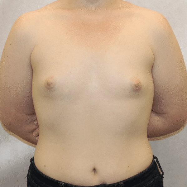 Case #5339 – Breast Augmentation