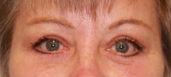 Case #538 – Eye Lift (Blepharoplasty)