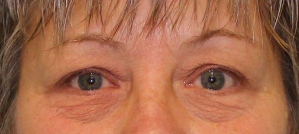 Case #538 – Eye Lift (Blepharoplasty)