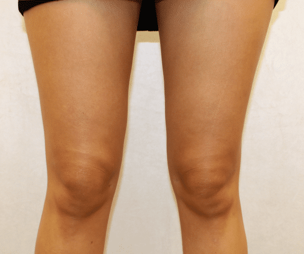 Case #5402 – Liposuction