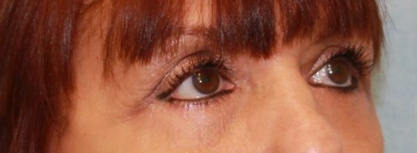 After Image: Case #550 – Eye Lift (Blepharoplasty) - right-front-oblique
