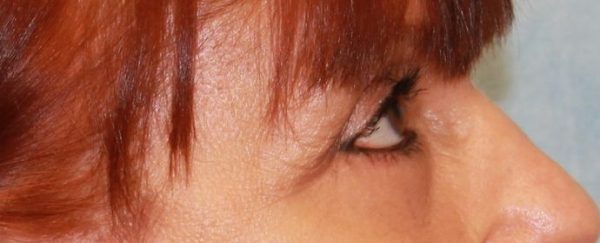 After Image: Case #550 – Eye Lift (Blepharoplasty) - right-side