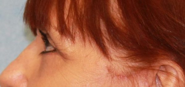 After Image: Case #550 – Eye Lift (Blepharoplasty) - left-side