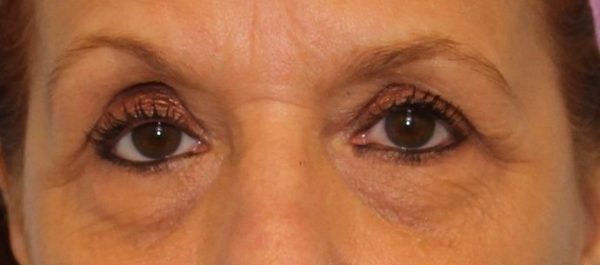 Case #550 – Eye Lift (Blepharoplasty)