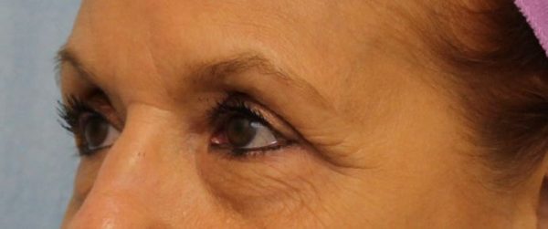Before Image: Case #550 – Eye Lift (Blepharoplasty) - left-front-oblique