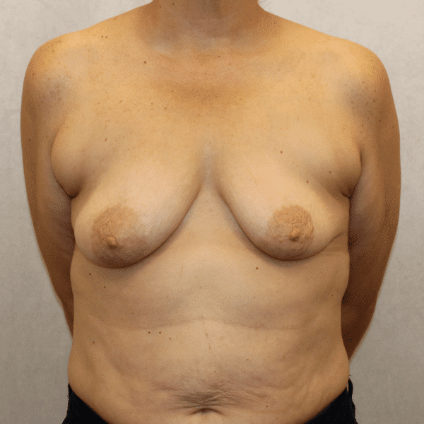 Case #5536 – Breast Lift