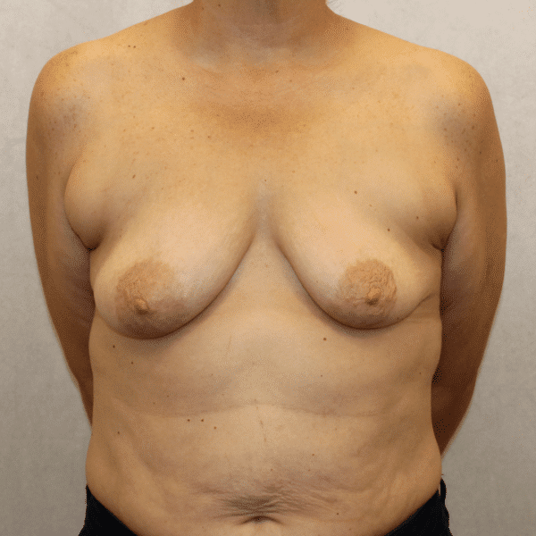 Before Image: Case #5536 – Breast Lift - front
