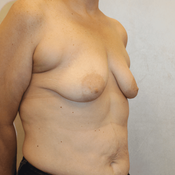 Before Image: Case #5536 – Breast Lift - right-front-oblique