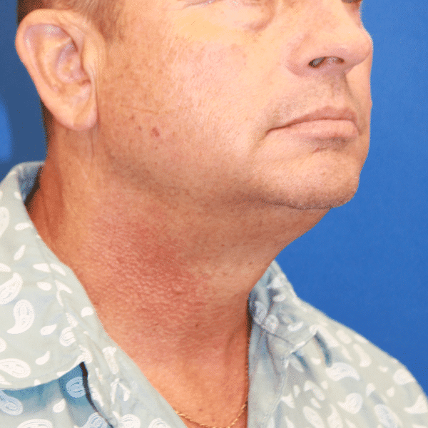 Before Image: Case #5558 – Anterior Platysmaplasty - right-front-oblique