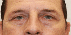 Case #5569 – Eye Lift (Blepharoplasty)