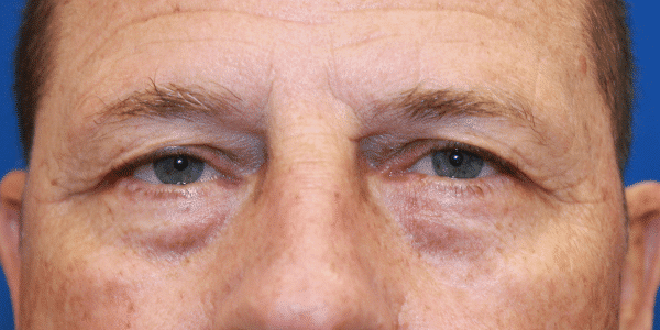 Case 5569 Eye Lift Blepharoplasty b1