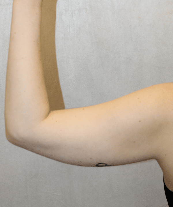 Before Image: Case #5572 – Liposuction - back