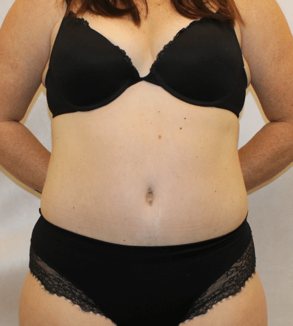 After Image: Case #5582 – Abdominoplasty – Tummy Tuck - front