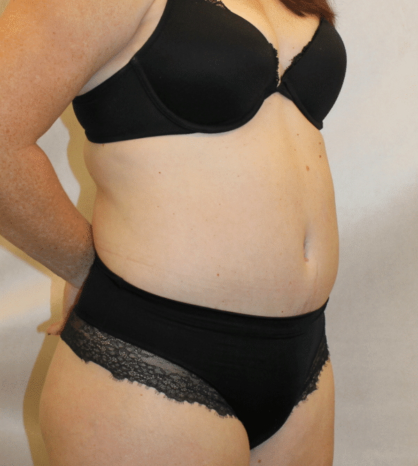 After Image: Case #5582 – Abdominoplasty – Tummy Tuck - right-front-oblique