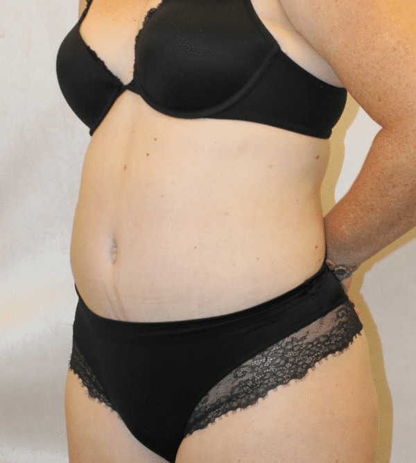 After Image: Case #5582 – Abdominoplasty – Tummy Tuck - left-front-oblique
